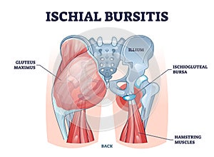 Ischial bursitis or ischiogluteal weaver's bottom condition outline diagram