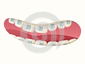 Isolated cartoon illustration of open mouth with teeth and dental braces.