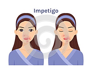 Isolated Cute cartoon Brunette woman with impetigo. Beautiful Face. Skin problems.