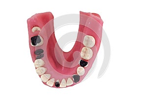 Isolated dental diseases model