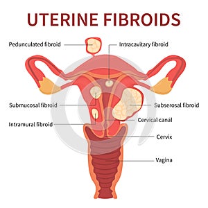 Uterine fibroids close-up view on white background
