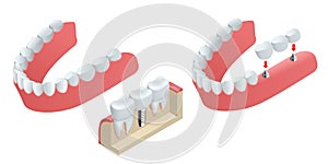 Isometric Tooth human implant. Dental concept. Human teeth or dentures. 3d illustration Isolated on white Realistic