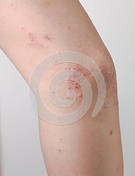 Itching caused by allergies, skin women.