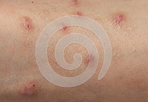 Itching caused by allergies, skin women.