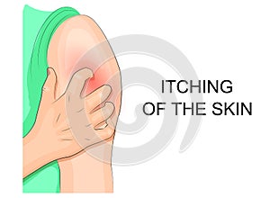 Itching of the skin, infection. hand combing shoulder