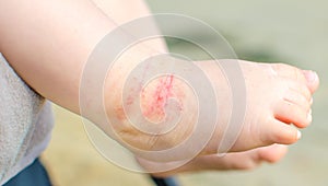 Prurito dermatite un bambino gamba 