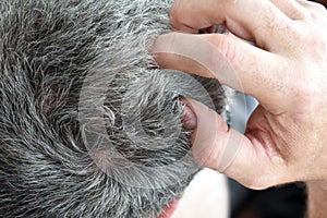 Itchy scalp. Caucasian man itching and scratching his head. Itchiness skin problem.