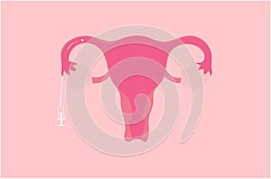 ITI Intratubal Insemination Illustration Vector