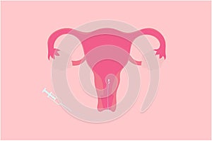 IUI Intrauterine Insemination Vector Illustration