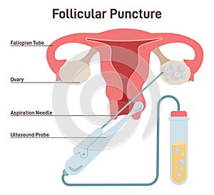 IVF. Follicular puncture, removing oocyte from the ovary of a woman