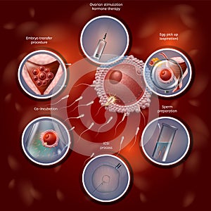 IVF Manually Combining Egg and Sperm in Lab Dish