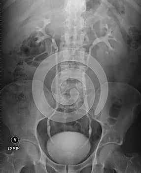 IVU xray for kidney stones photo