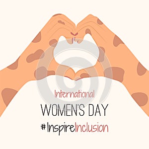 IWD design with depigmentation white hands show Heart Shape Card. Minimalist International Women s Day 2024 Poster