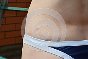 Ixodes scapularis, black legged tick or deer tick, transmitter of lyme and borrelia disease on the  back of a women photo