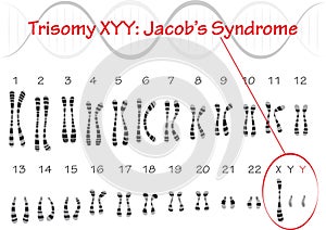 Jacobs syndrome Trisomy XYY vector illustration graphic