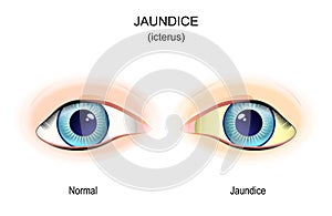 Jaundice. Comparison and difference of normal eye, and eye with icterus