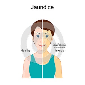 Jaundice. The Comparison between Healthy person and person with Icterus