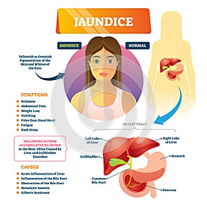 Jaundice or icterus vector illustration. Labeled yellowish disease scheme.