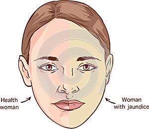 Jaundice vector images, illustrations, and clip art