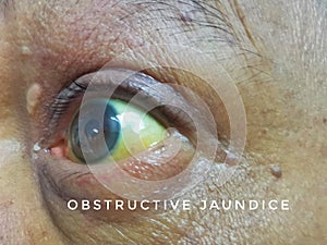 Jaundice or yellowish discolouration of sclera due to Obstructive Jaundice in Pancreatic Cancer