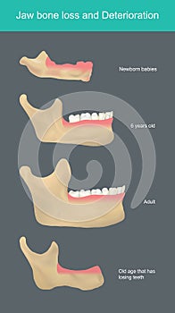 Jaw bone loss and Deterioration. Illustration.