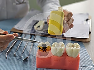 Jaw model with electronic vaping device. Vaping causes tooth decay