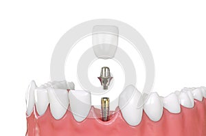 Jaw model tooth implant 3d illustration photo