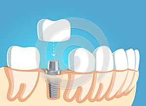 Jaw part model with teeth row and dental implant