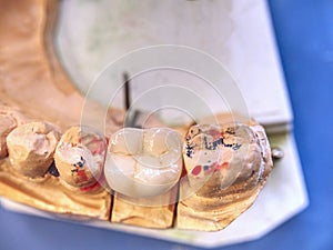 Jaw plaster cast with fixed dentures in Prothetic laboratory photo