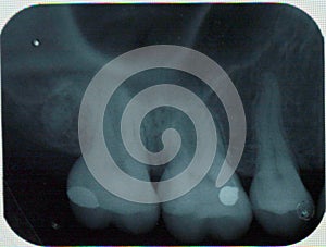 jaw x ray of left uper teeth