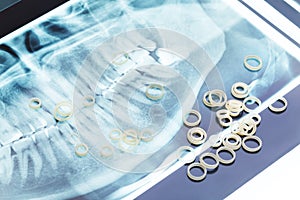 Jaw xray and orthodontic latex rings for braces photo