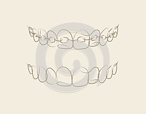 Jaws with and without braces installed beige color
