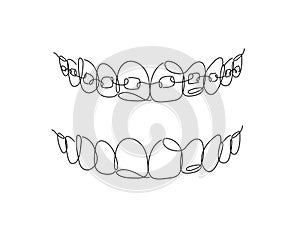 Jaws with and without braces installed flat line
