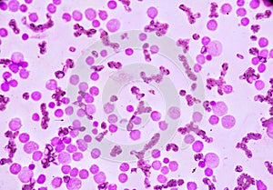 JBlood smear under microscopy showing on Adult acute myeloid leukemia AML is a type of cancer in which the bone marrow makes abn photo