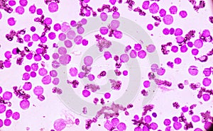 JBlood smear under microscopy showing on Adult acute myeloid leukemia AML is a type of cancer in which the bone marrow makes abn photo