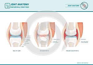 Joint anatomy, osteoarthritis and rheumatoid arthritis infographic photo