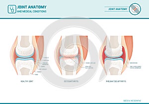 Joint anatomy, osteoarthritis and rheumatoid arthritis infographic