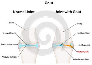Joint with Gout