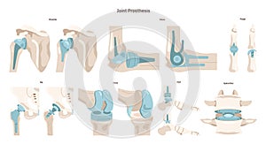 Joint implantation set. Injured or distracted human joint replaced photo