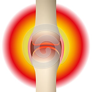 Joint Pain Rheumatism Synovial Joint