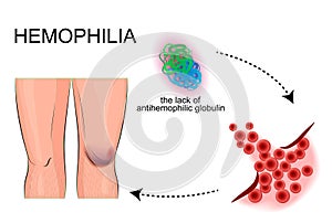 The joints hemophilia. bleeding. injury.