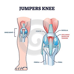 Jumpers knee or patellar tendonitis tendon bone inflammation outline diagram