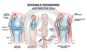 Juvenile idiopathic arthritis or JIA anatomical explanation outline diagram