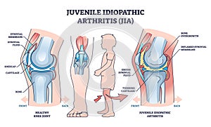 Juvenile idiopathic arthritis or JIA anatomical explanation outline diagram photo