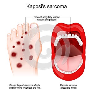 Kaposi`s sarcoma. cancer. skin lesions photo