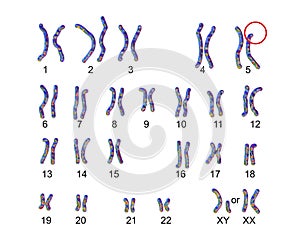 Karyotype of Cri du chat, or cat's cry, syndrome, also known as 5p- syndrome