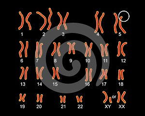 Karyotype of Cri du chat, or cat's cry, syndrome, also known as 5p- syndrome