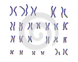 Karyotype of Cri du chat, or cat's cry, syndrome, also known as 5p- syndrome