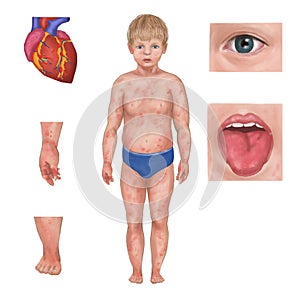 Kawasaki disease symptoms. Common signs of Kawasaki syndrome photo