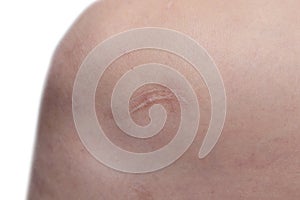 Keloid scar on skin